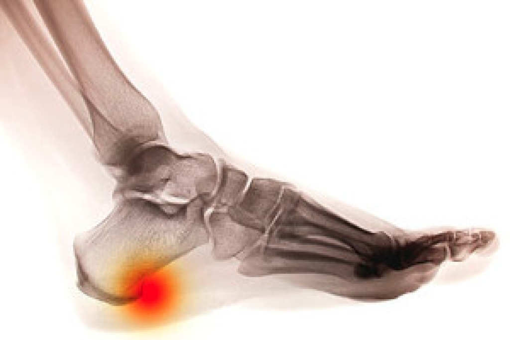 Definition of a Heel Spur