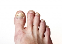 Toenail Fungus Can Cause Discoloration