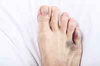 How Do I Know if My Toe Is Broken?