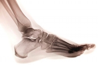 What Is a Metatarsal Stress Fracture?