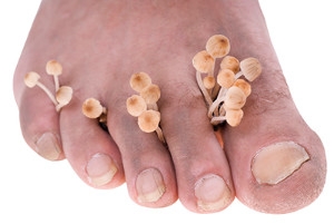 Athlete&#039;s Foot Causes Itching
