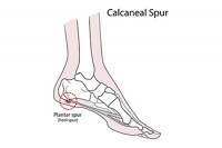 Painful Heel Spurs