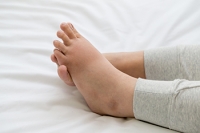 Foot Swelling During Pregnancy