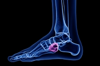 What Might Cause Pain in the Middle, Outside Part of the Foot?