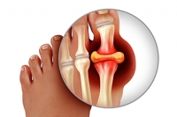 Strategies to Help Prevent Gout